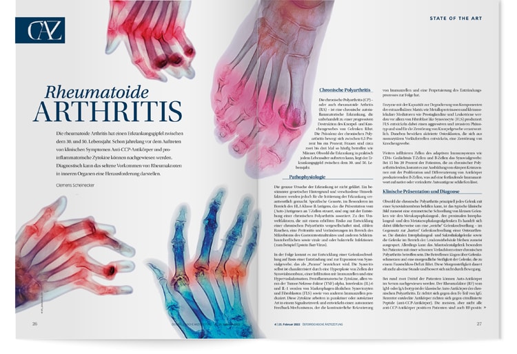 State of the Art: Rheumatoide Arthritis