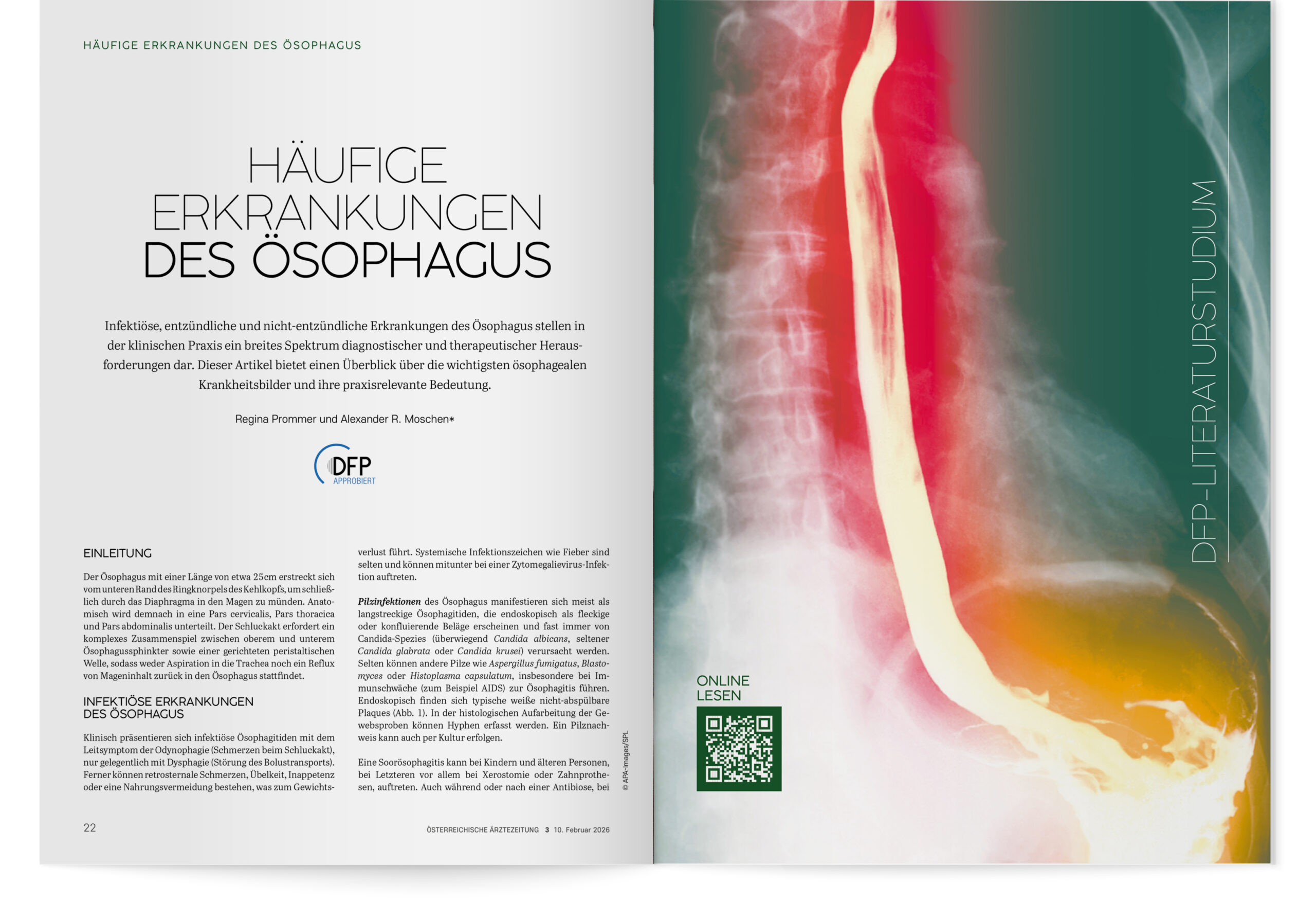 DFP-Literaturstudium: Häufige Erkrankungen des Ösophagus
